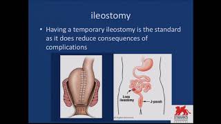 Laparoscopic and single port J-pouch surgery - Pramodh Chandrasinghe