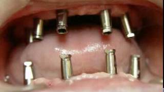 Prótesis atornilladas sobre implantes dentales.mpg