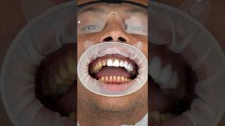 Veneers can change your smile forever #dentist #shorts #zirconiacrown