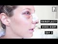 Rhinoplasty Video Diary - Day 3 After Surgery (2 of 15)