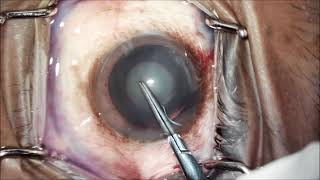 Routine cataract surgery