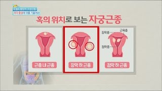 [Happyday] Uterine myoma everything about 자궁근종, '00'경우에는 제거 필수! [기분 좋은 날] 20160329