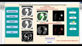 Matlab Code for Lung Nodule Detection Using Image Processing | With Source Code