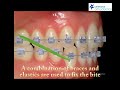 correcting an underbite at orleans orthodontics