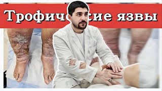 Клинический случай: пациент с трофическими язвами