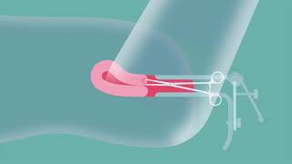 IUD Procedure with Tenaculum