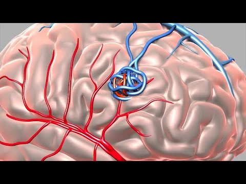 Can venous angiomas cause severe headaches?