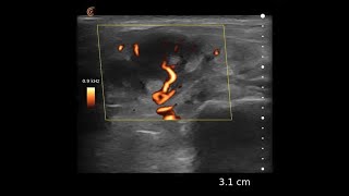 Lymph Node – Ultrasound Image Interpretation