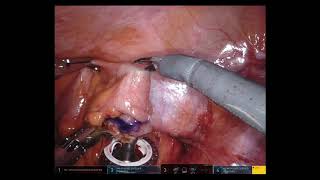 Total Intracorporeal Sigmoid Colectomy with Transrectal Extraction