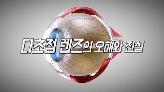 백내장 수술 뒤 선택하게 될지도 모르는 다촛점렌즈 삽입술의 오해와 진실? 과연 인간의 수정체를 대체?