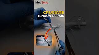 Cruciate Repair: Learn This ASAP #tendon #suture #surgery #meded #medicalstudent