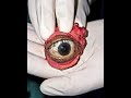 This Patient's EYE was removed to prevent a DEADLY Infection from spreading into BRAIN