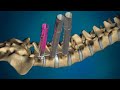 Orthofix: Phoenix MIS Percutaneous Screw Placement