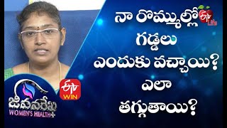 నా రొమ్ముల్లో గడ్డలు ఎందుకు వచ్చాయి? ఎలా తగ్గుతాయి? | జీవనరేఖ ఉమెన్స్ హెల్త్  | 9th మార్చి 2021 