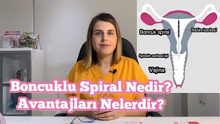 Boncuklu Spiral Nedir? Boncuklu Spiral Antalya - Op. Dr. Funda Yazıcı Erol