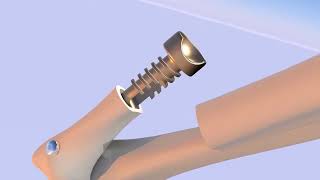 Intraosseous Distal Radioulnar Joint (DRUJ) Prosthesis