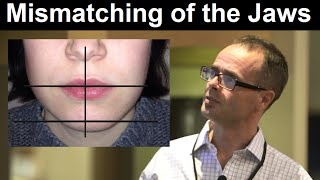 Effect of Midline Discrepancy/ Mismatching or Facial Asymmetry on Facial Appearance by Dr Mike Mew