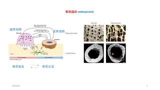 认识骨质疏松，防止骨折和并发症。（讲座之一）