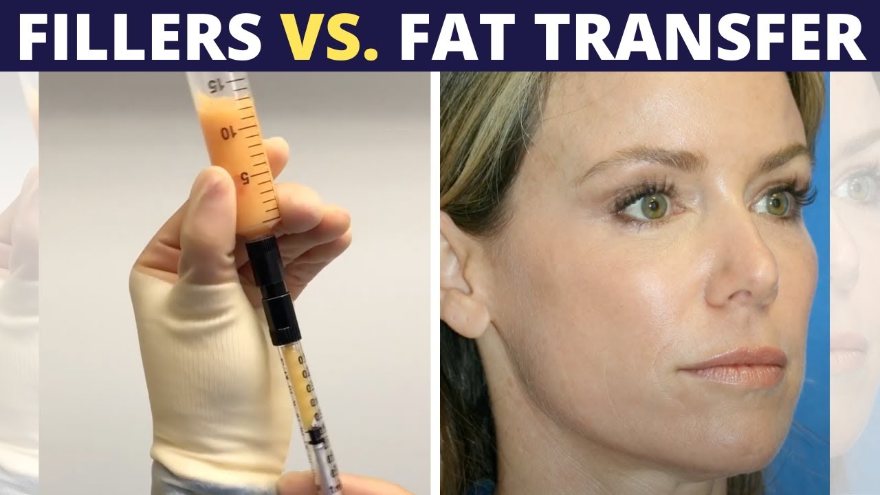 Fat Transfer Vs Fillers What S The Difference Youtube
