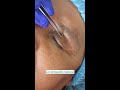 blefaroplastia sin cirugia