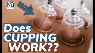 Cupping Therapy 101: Best Practices, Benefits, and Common Misconceptions Debunked