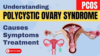 Understanding Polycystic Ovary Syndrome | PCOS Causes, Symptoms, and Treatment