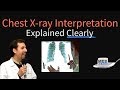 Chest X-Ray Interpretation Explained Clearly - How to read a CXR