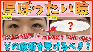 【まぶたの脂肪】厚ぼったい瞼の改善｜眉下切開とまぶたの脂肪取りとROOF切除を比較解説