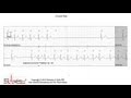 ECG Interpretation Tutorial - ChalkTalk 86 - Intermediate Level