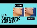 Lip Aesthetic Surgery || Shah Plastic Surgery NYC || Before After