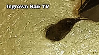 Ingrown hair removal zoom in plucked hair three together