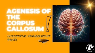 Agenesis of the Corpus Callosum | Pediatrics | Congenital Anomalies of Brain | Pedia-Time