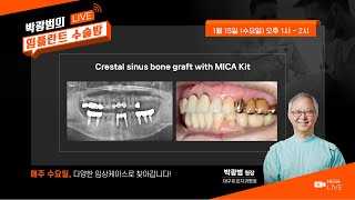 Crestal sinus bone graft with MICA Kit