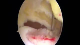 Arthroscopic Osteochondral Autograft Transfer for Juvenile Osteochondritis Dissecans...