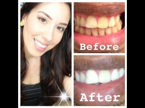 My At Home Teeth Whitening Routine (WITH BEFORE AND AFTER PICTURES ...