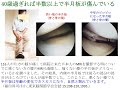 膝サポーターの内側にパッドを着けると飛びだした半月板が押し戻される