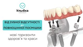 Відновлення посмішки: Протезування при відсутності всіх зубів - All-on-4