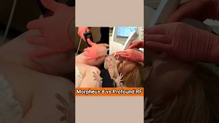 Morpheus 8 vs Profound RF #microneedling #antiaging