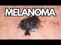 Understanding Melanoma In Seniors: Risks, Challenges and Importance of Addressing Skin Cancer