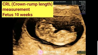 10 weeks fetus ultrasound. CRL measured. Detailed view. Head, body, organs, extremities, movements.