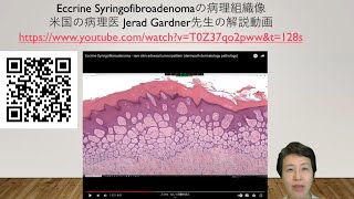 eccrine syringofibroadenomaの病理組織像の解説