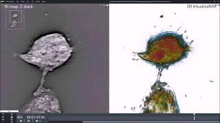 Glioblastoma cells undergoing autophagy observed with holo-tomographic microscope