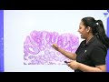 2nd prof mbbs crash course general pathology neoplasia dr. priyanka sachdev