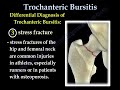 trochanteric bursitis hip bursitis everything you need to know dr. nabil ebraheim