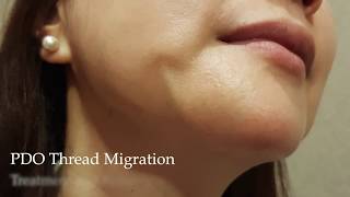 PDO Thread Lift Complication - Thread Migration. Removal of thread