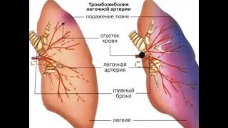 Легочная эмболия