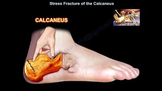 Stress Fracture of the Calcaneus - Everything You Need To Know - Dr. Nabil Ebraheim