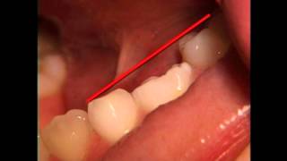 Pediatric Ankylosis Diagnosis in Pediatric Dentistry | Lake Merritt Dental, Oakland, CA