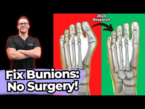 How can I shrink my bunions naturally?