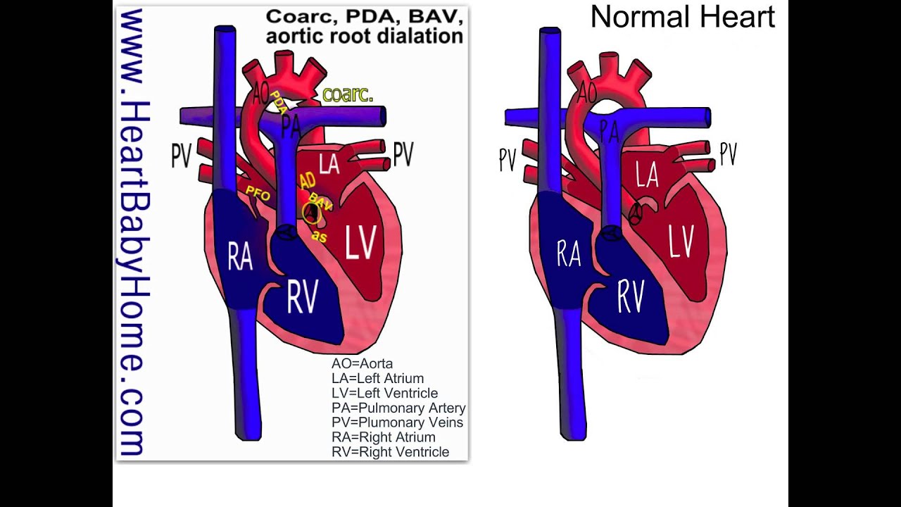 44 Coarctation Of The Aorta, Bicuspid Aortic, Aortic Root Dilation ...